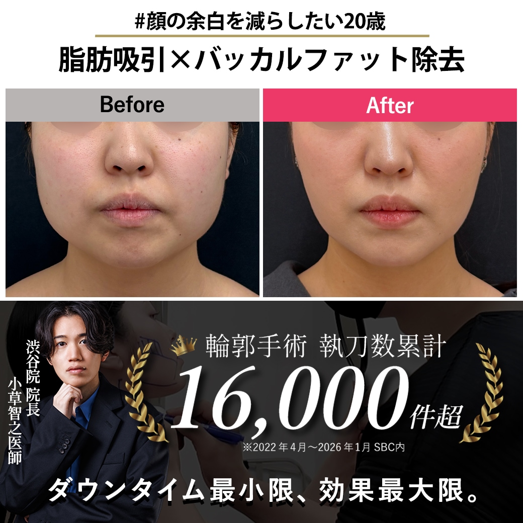 【顔の脂肪吸引の名医】脂肪吸引×バッカルファット除去で顔の余白を減らす【脂肪吸引が上手いおぐさ先生】