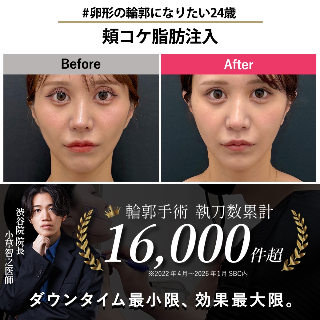 【顔の脂肪注入の名医】頬コケ脂肪注入で卵形の輪郭に【脂肪注入が上手いおぐさ先生】