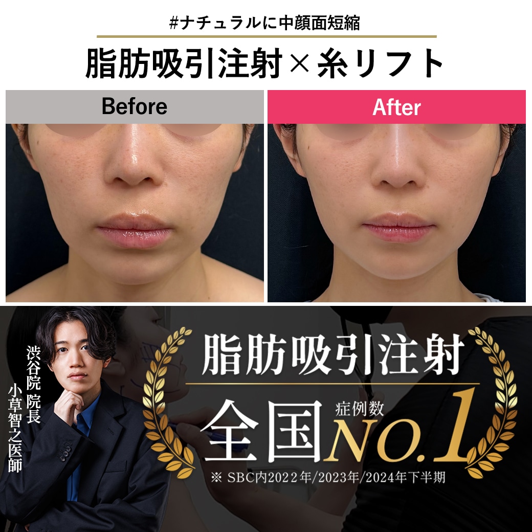 【脂肪吸引注射の名医】脂肪吸引注射×糸リフトで中顔面短縮