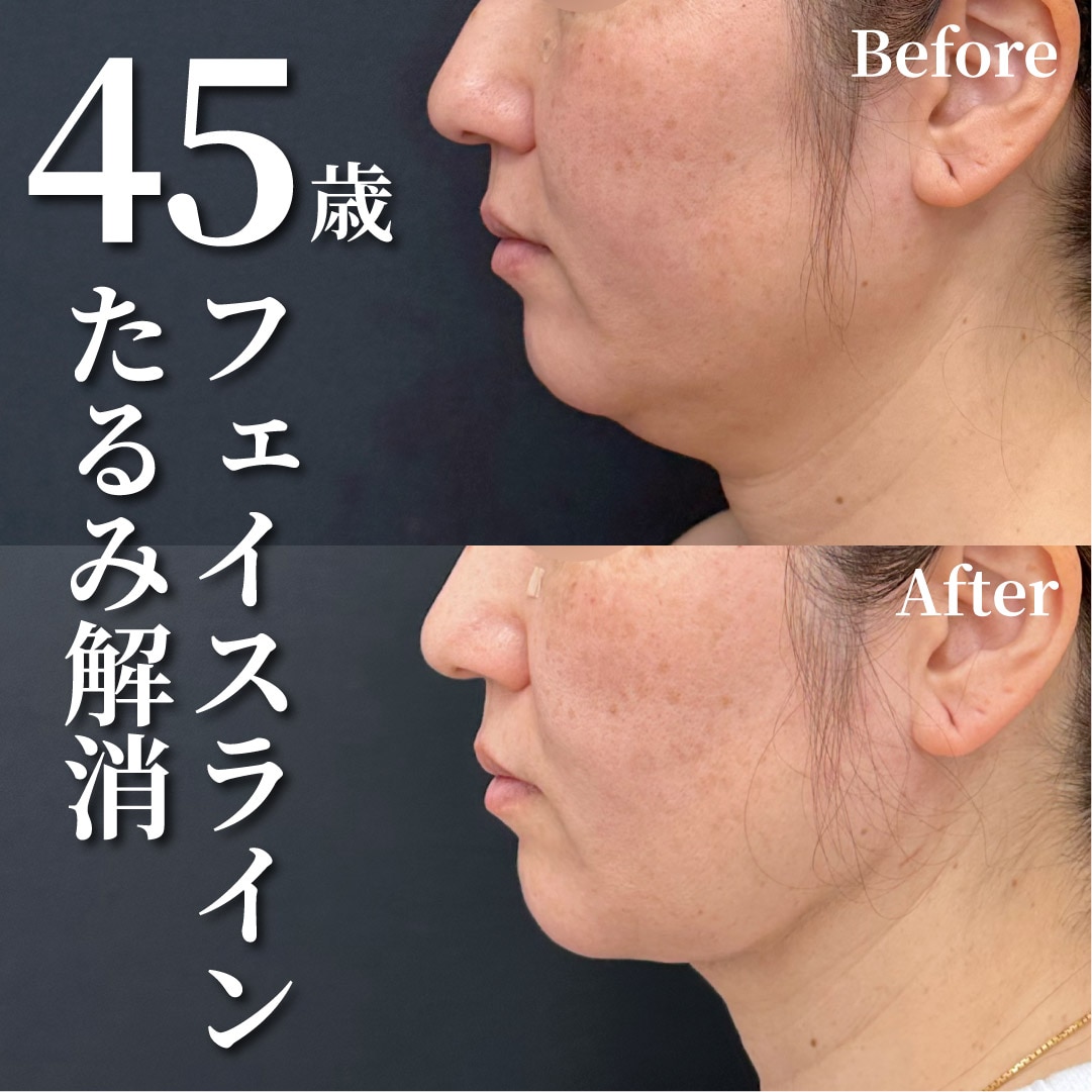 45歳女性のモニター様