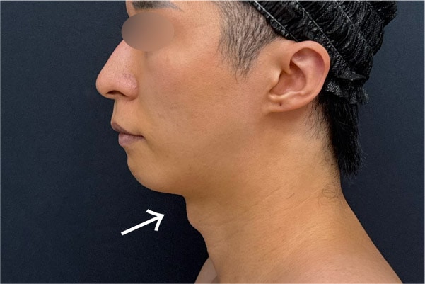 男性の”あご下ピタッと”は難しい？