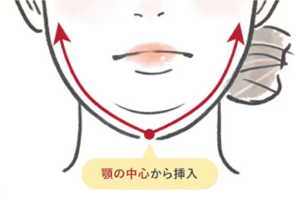 あご下もたつきには、”脂肪吸引×顎下スッキリフト”