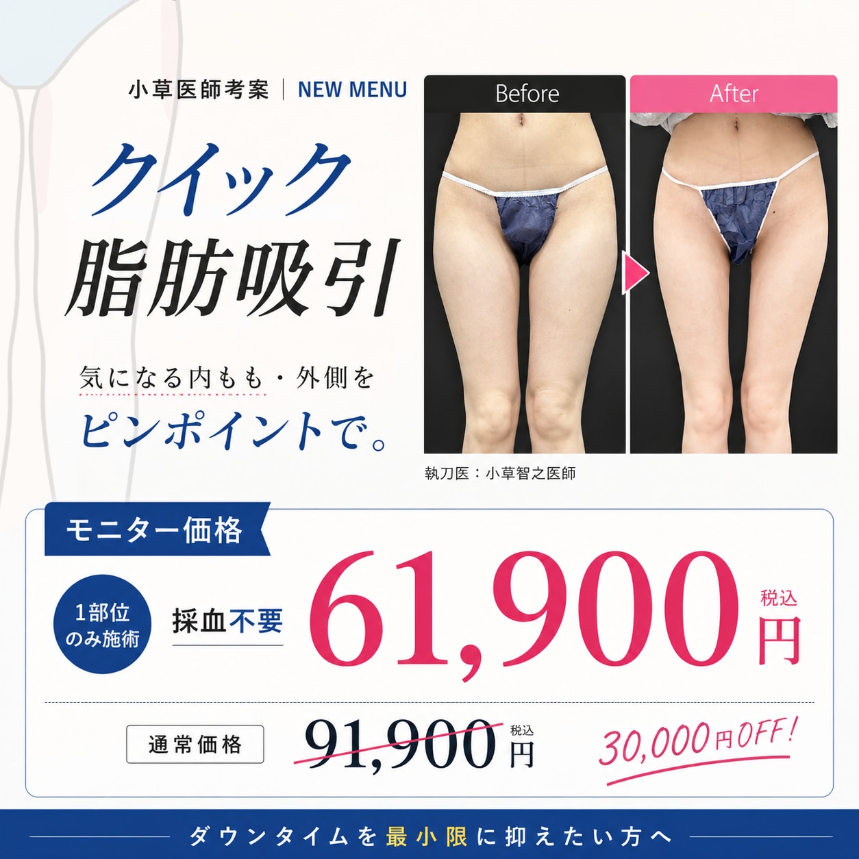 【クイック脂肪吸引】太ももに隙間を！9万円台で叶うダウンタイムを抑えた部分痩せ