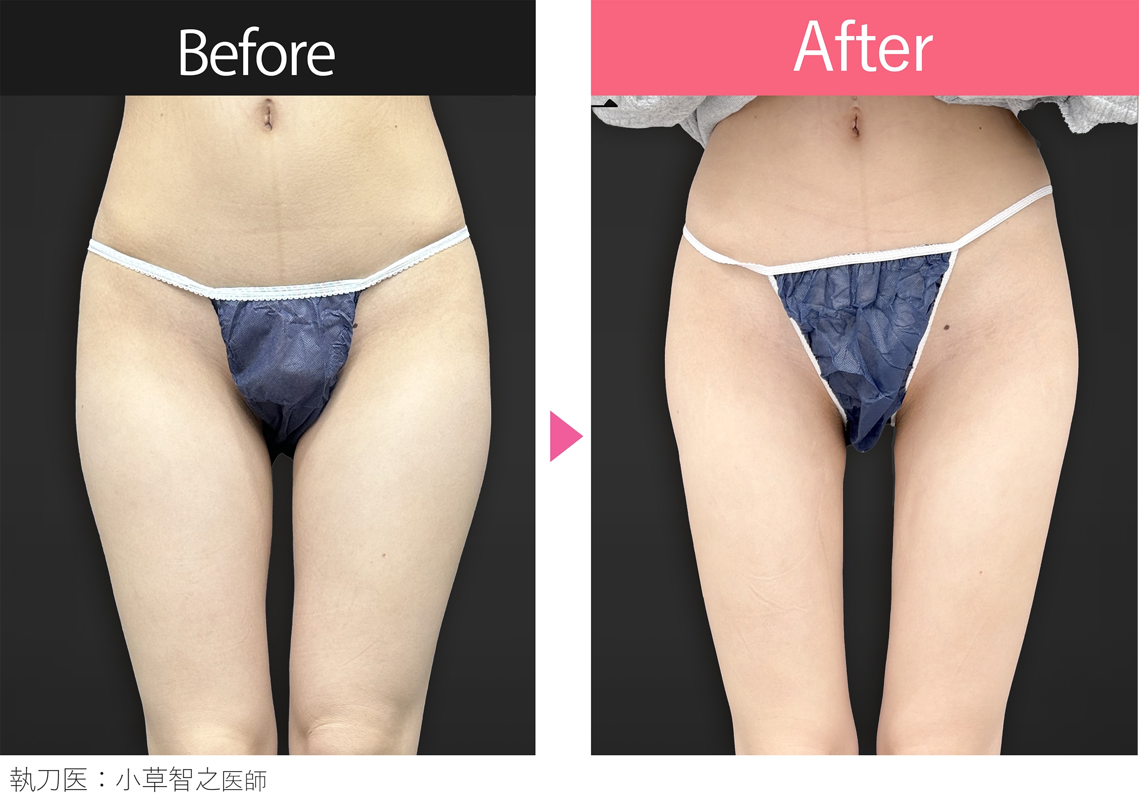 気になる内ももと外ももがスッキリ