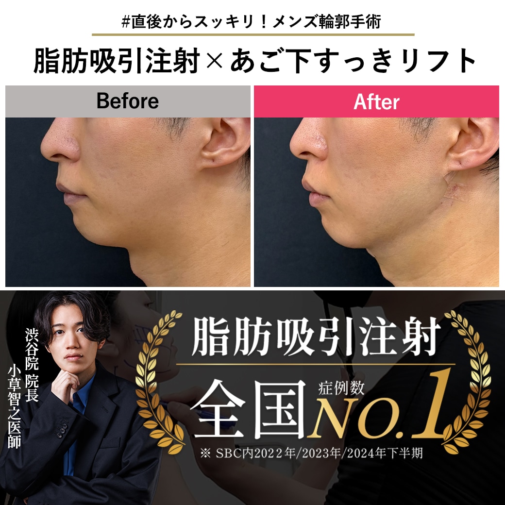 【脂肪吸引注射の名医】直後からあご下スッキリ！メンズ輪郭手術