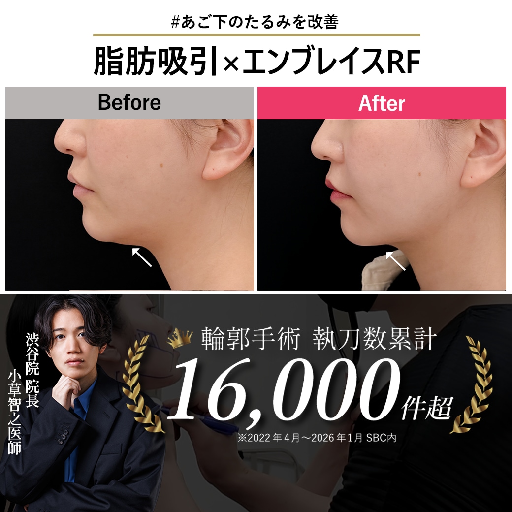 【顔脂肪吸引の名医】他院で断られたあご下もスッキリ！確かな技術でコンプレックス解消