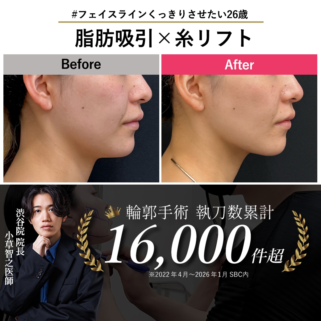 【顔の脂肪吸引の名医】26歳のアゴ下脂肪吸引×糸リフト【脂肪吸引が上手い小草先生】