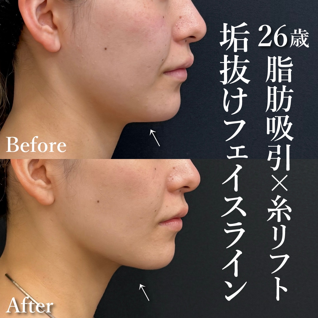 20代女性のモニター様