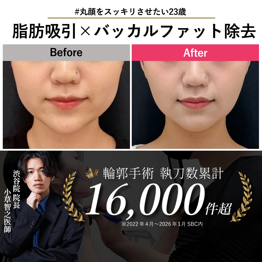 【顔の脂肪吸引の名医】23歳のバッカルファット除去【脂肪吸引が上手い小草先生】