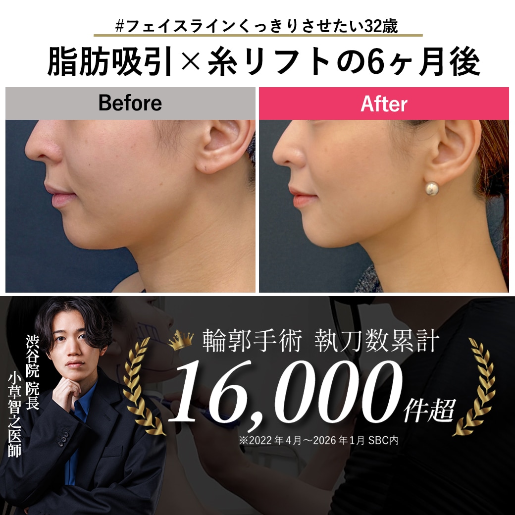 【顔の脂肪吸引の名医】32歳の脂肪吸引×糸リフトの6ヶ月後【脂肪吸引が上手い小草先生】