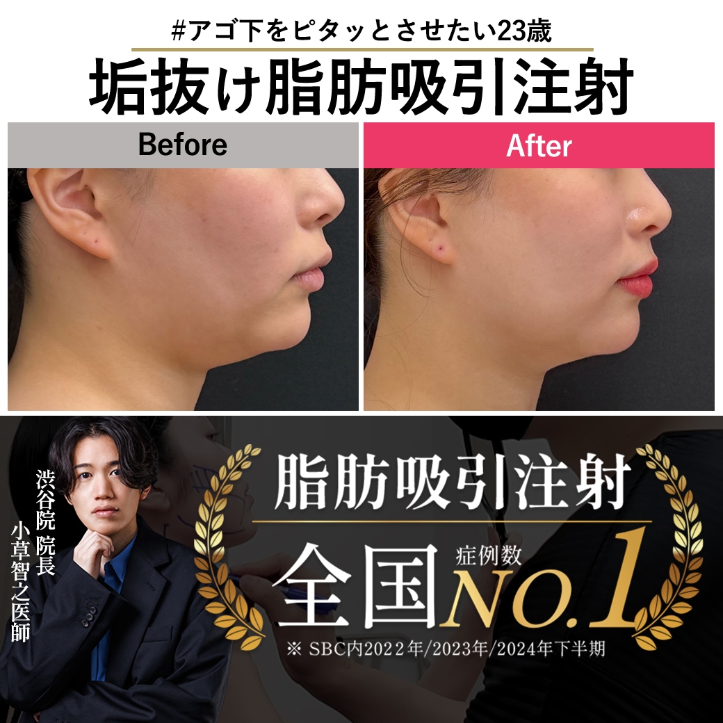 【ちょっと違うと、かなり違う】ダイエットのモテベーションにしたい23歳の脂肪吸引注射