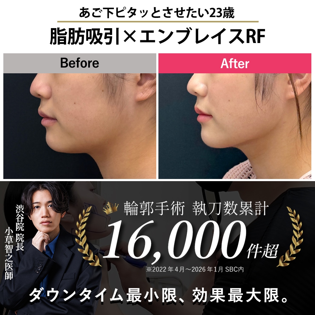 【顔の脂肪吸引の名医】あご下ピタッとさせたい23歳【脂肪吸引が上手いおぐさ先生】