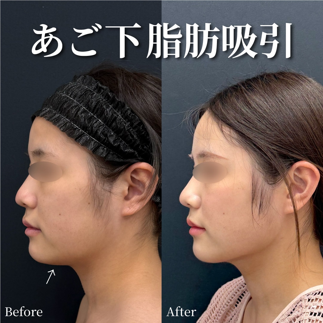 23歳女性のモニター様