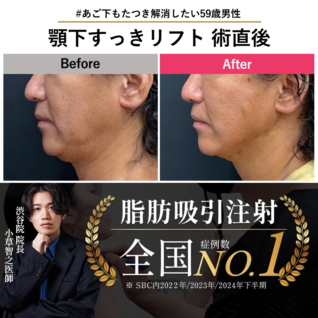【糸リフトの名医】59歳男性 顎下すっきリフトで術直後から横顔激変