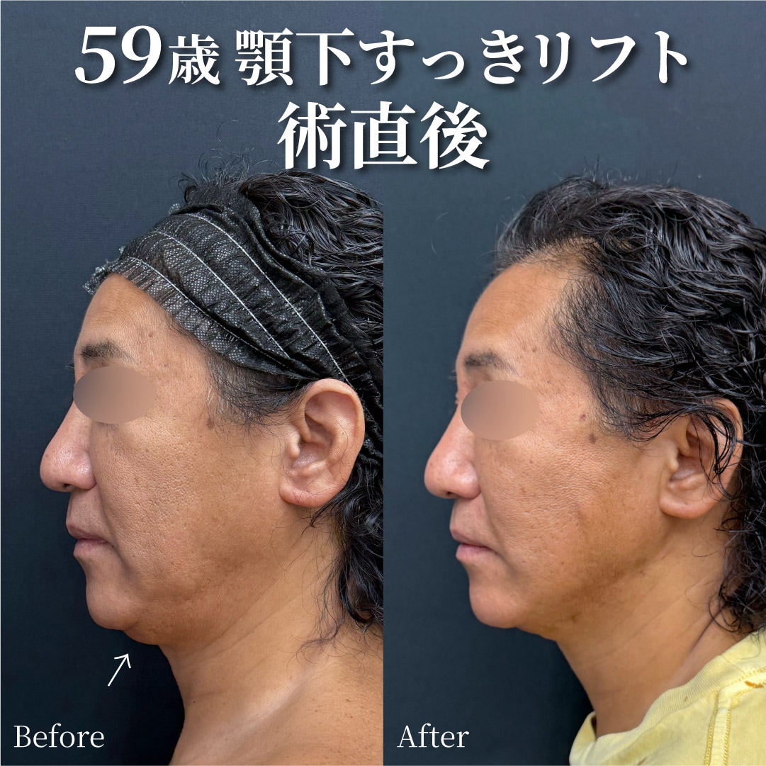 59歳男性のモニター様