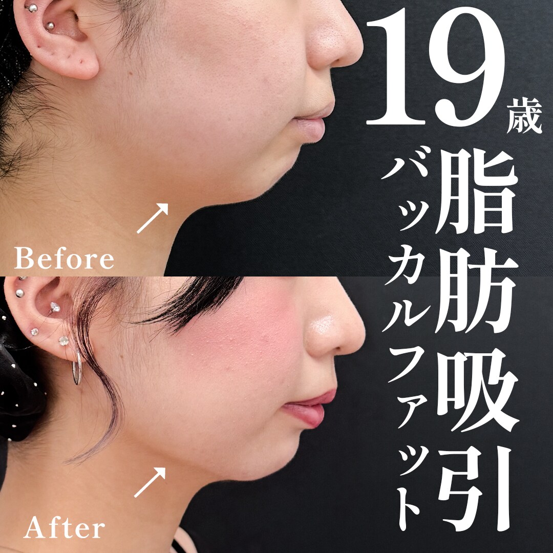 10代女性のモニター様