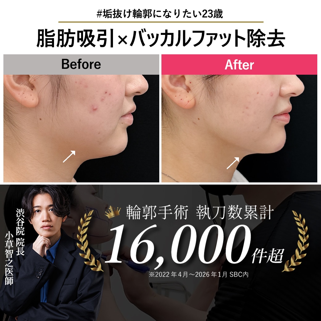 【顔脂肪吸引の名医】無加工カメラも怖くない!友人から褒められる「アプリいらず」のシャープな輪郭へ