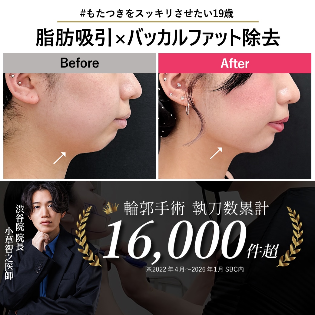【顔脂肪吸引の名医】19歳で叶える理想の輪郭!バッカルファットとメーラーファット除去でスッキリ小顔とEライン