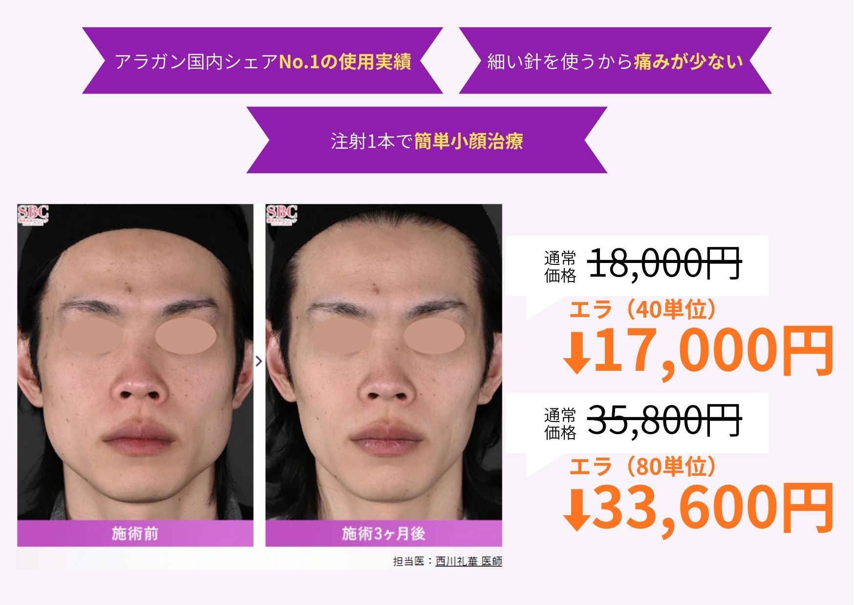 アラガン製ボトックス【エラ】