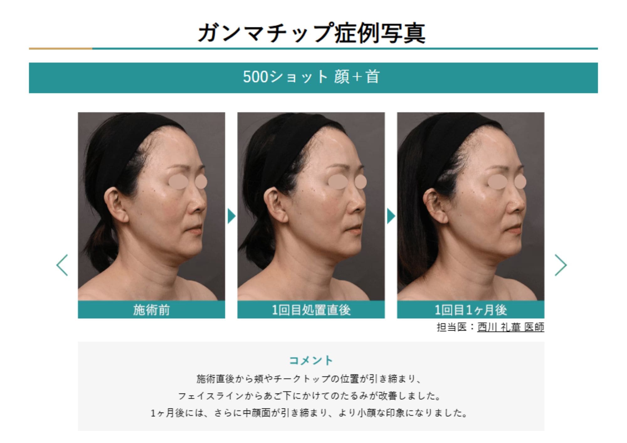 切らずにたるみと肌質をWケアする「デンシティ（Density）」の魅力