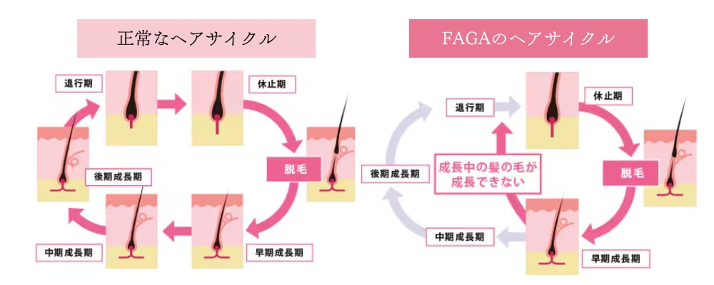 膝痛 髪の毛抜け毛 ミネラル （クリニック監修】抜け毛はなぜ起きる 