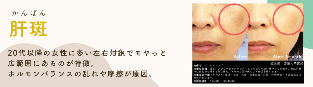 【肝斑】