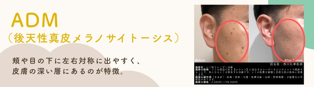 【ADM＝後天性真皮メラノサイトーシス】
