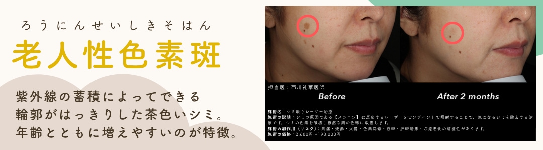 【老人性色素斑】