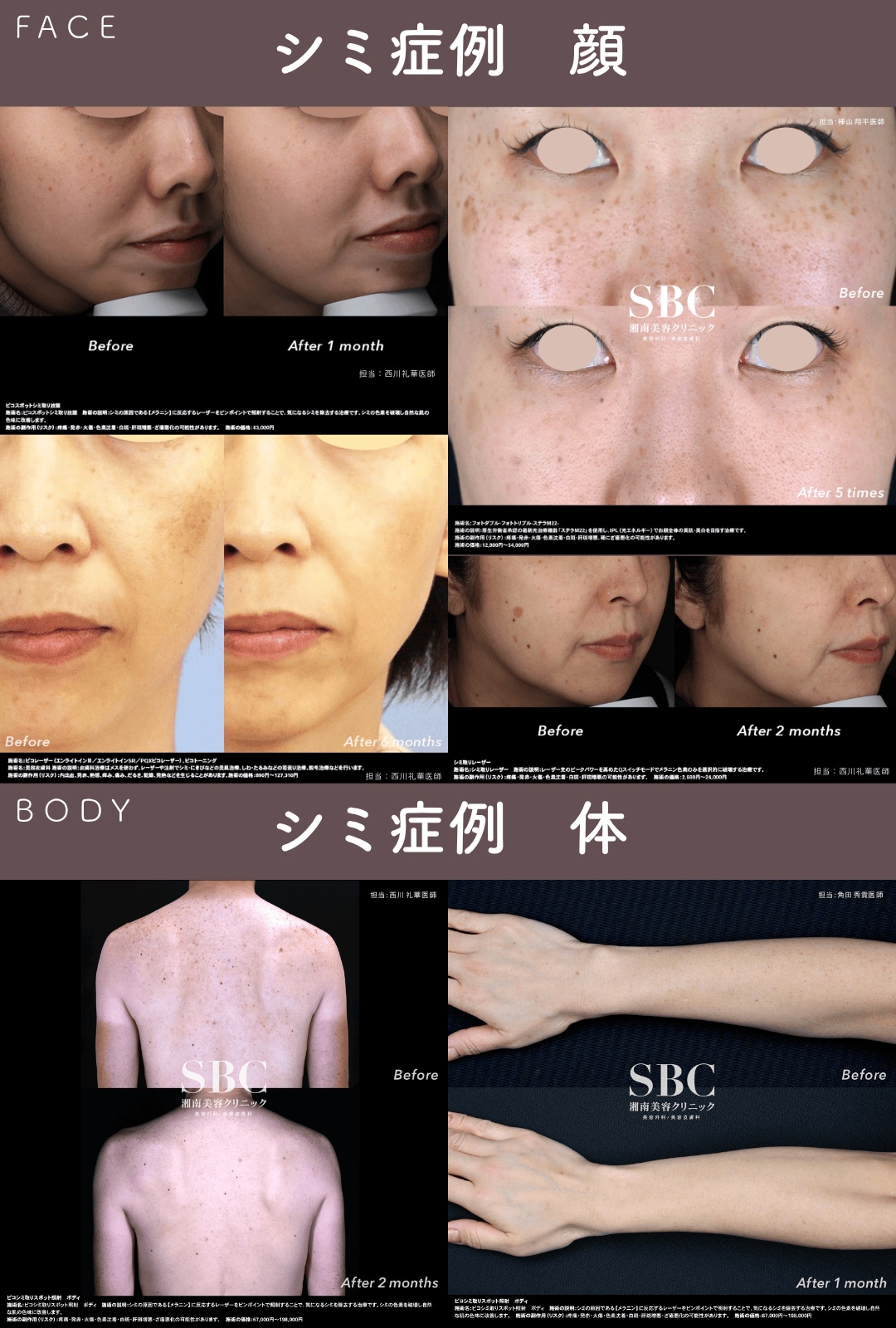 湘南美容クリニックのシミ取り