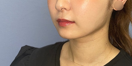 吸引王のオーダーメイド小顔術