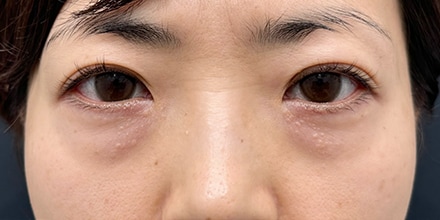 おすすめ治療（目元）