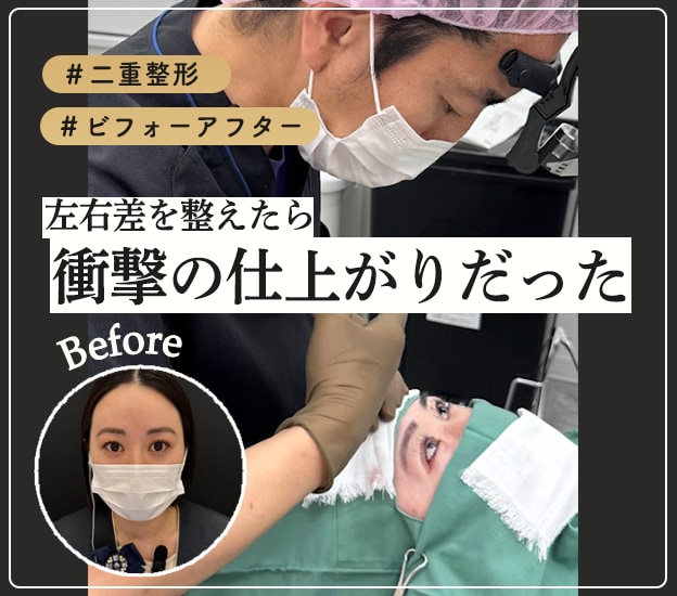 【衝撃変化！】二重整形のリアルをお届け！左右差を整えたら…スタッフが手術を受けました！