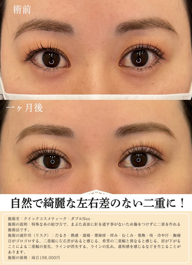 左右非対称だった二重幅が・・