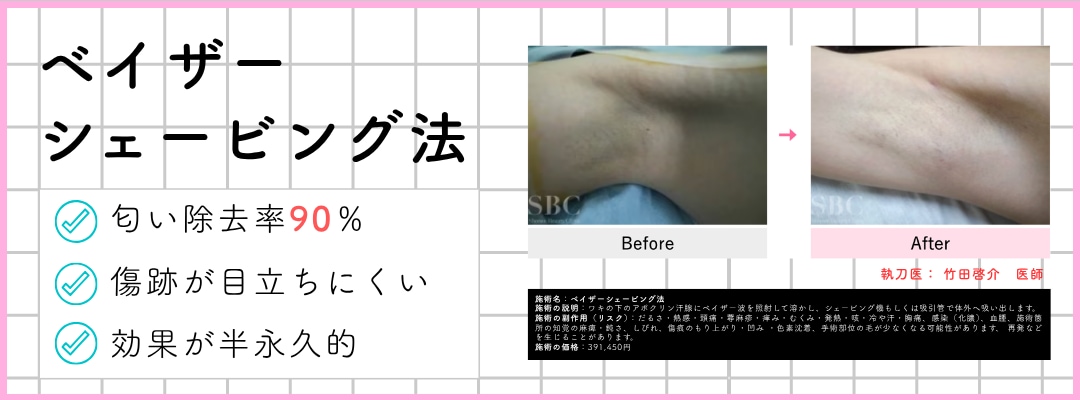 ベイザーシェービング法