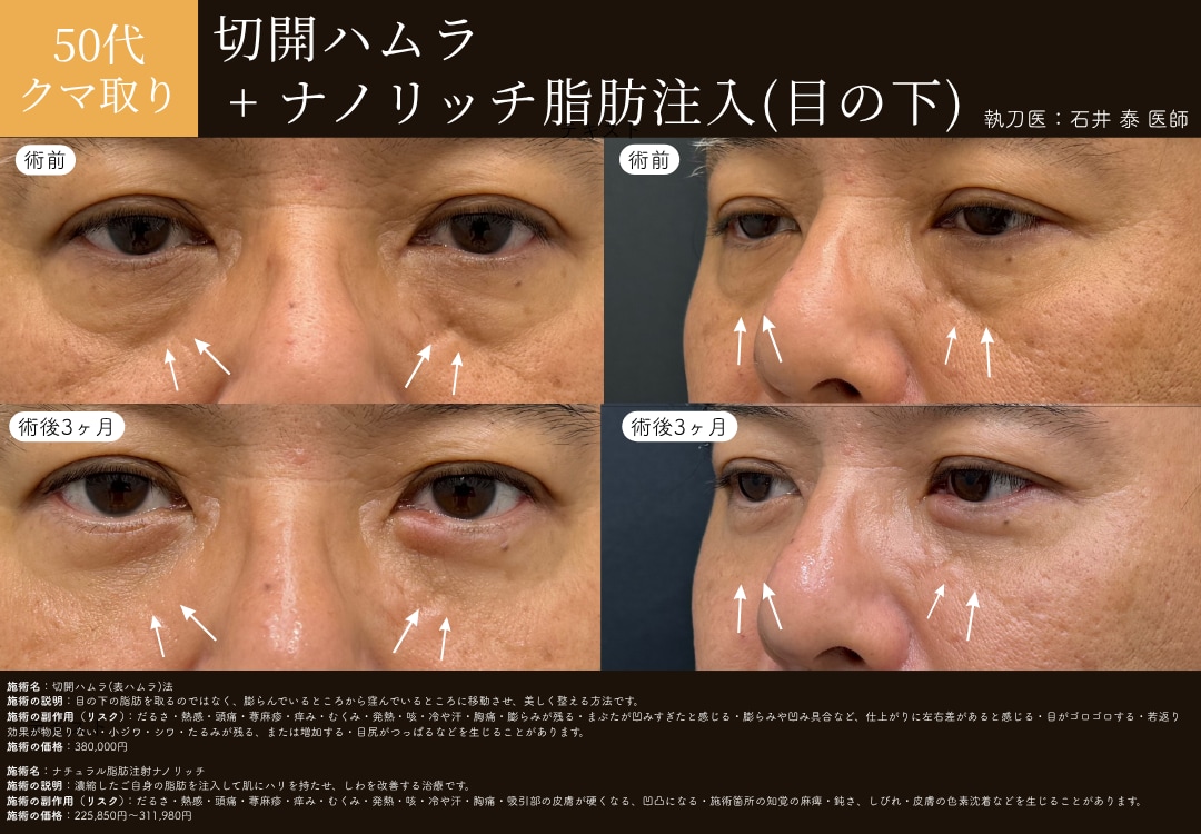 切開ハムラ法