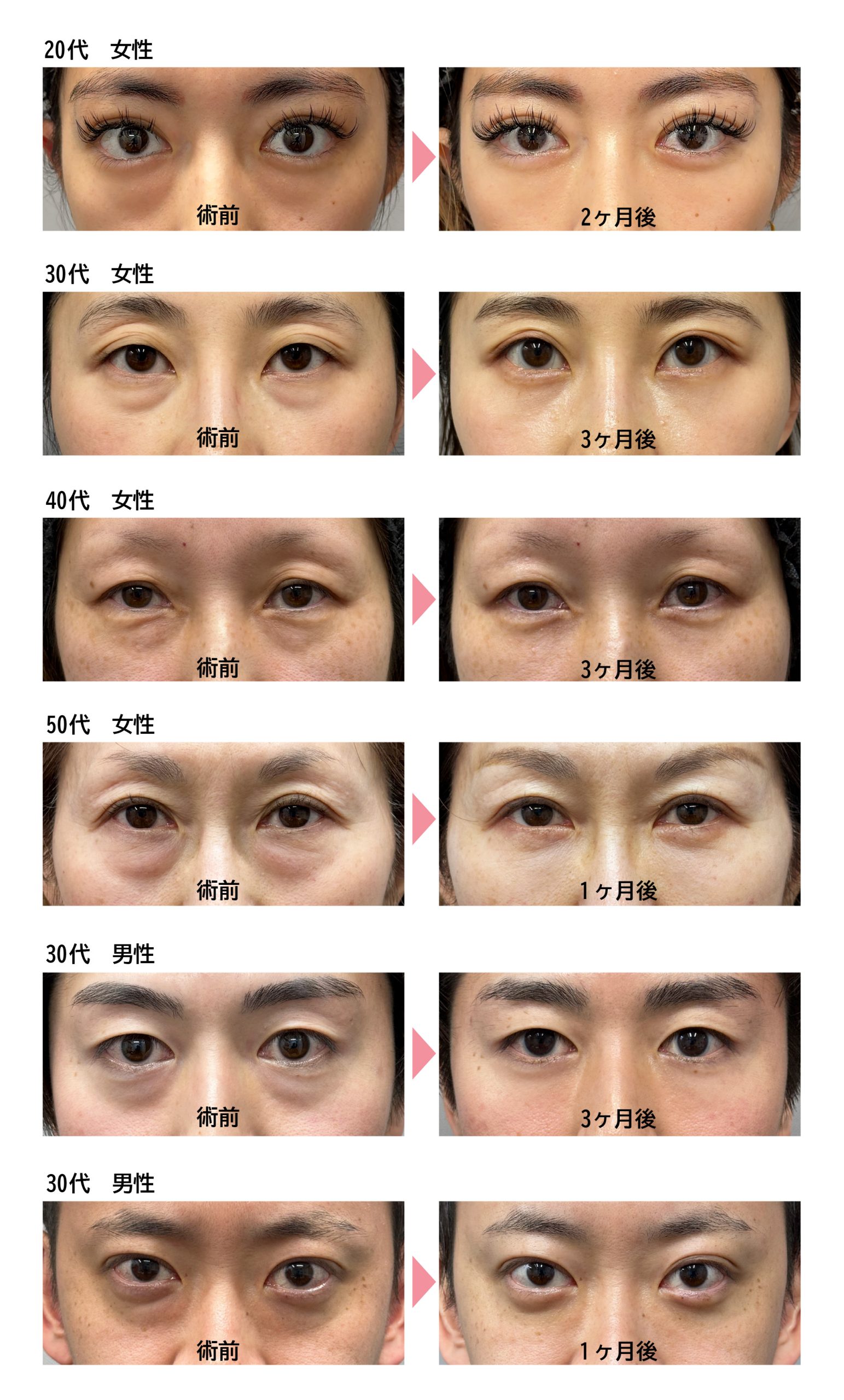 クマ取り名医】症例数全国No.1！『クマ・たるみ取り』ならSBC品川院の  