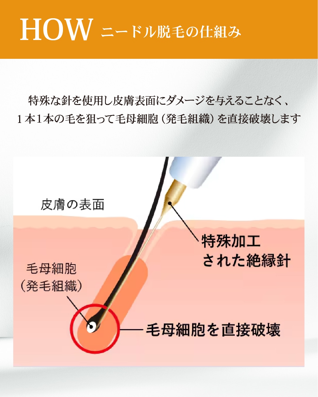 ニードル脱毛の仕組み