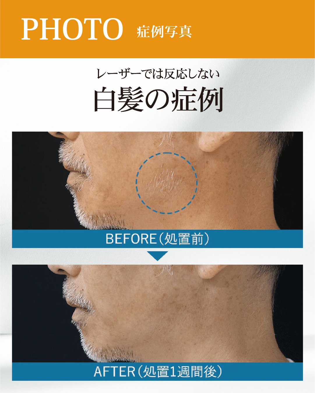 白髪の症例