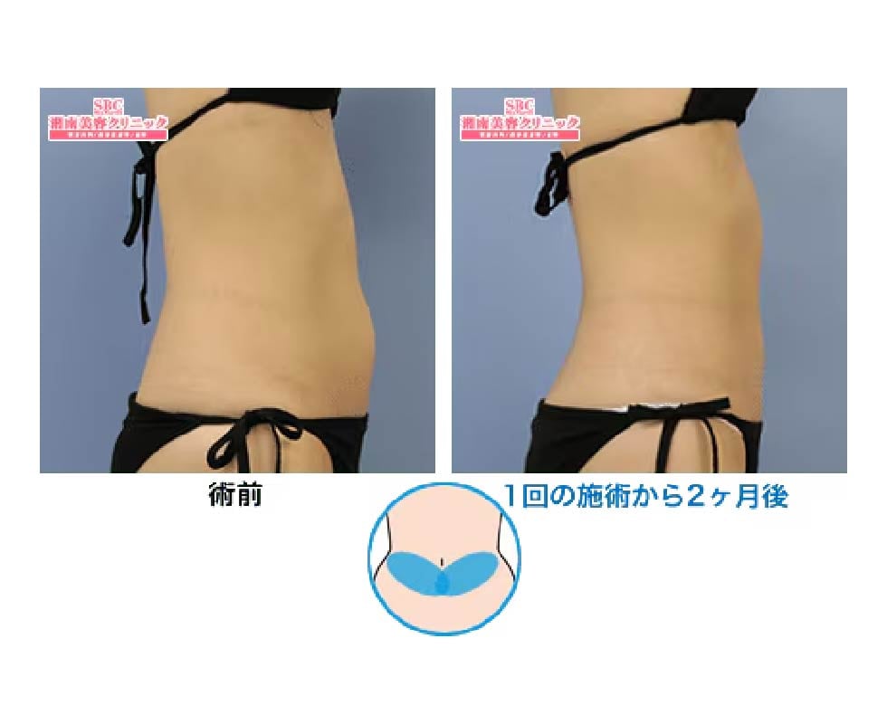 下腹部２エリア