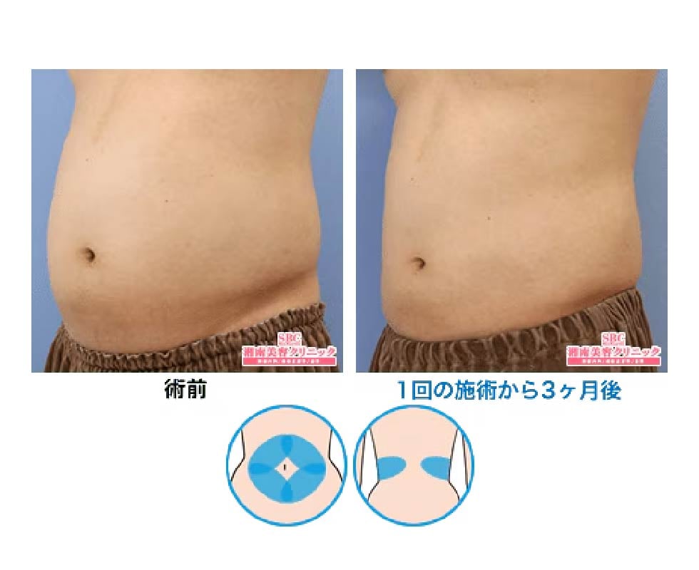 お腹全体6エリア