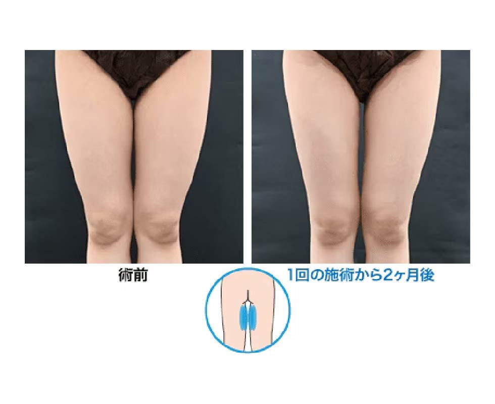 内腿4エリア