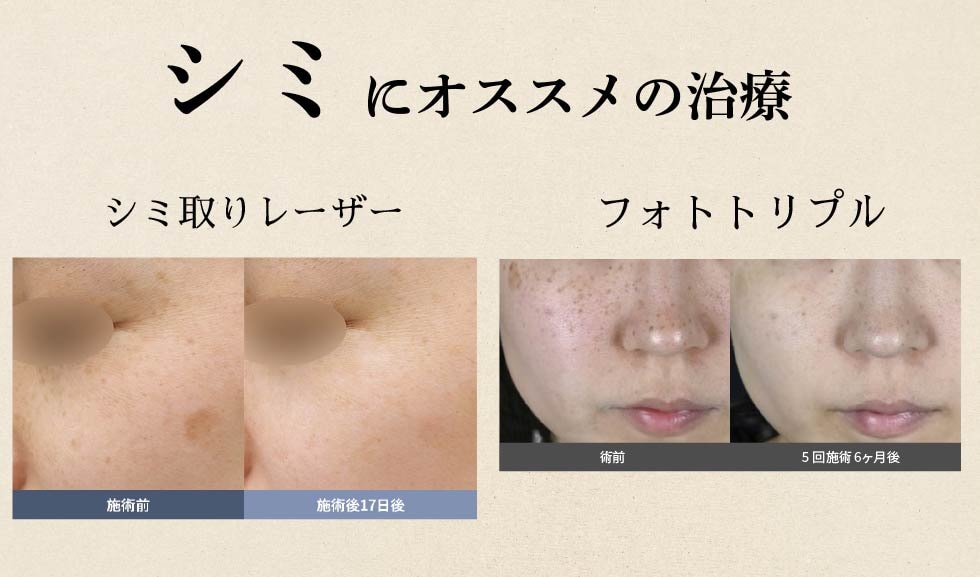 シミにお悩みの方へ