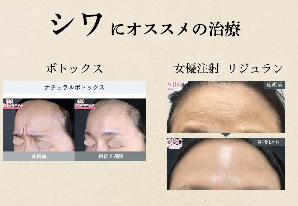 シワでお悩みの方へ