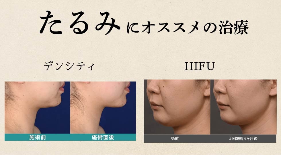 たるみでお悩みの方へ