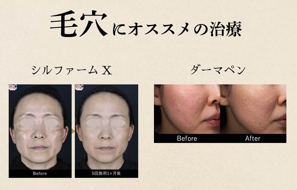 毛穴でお悩みの方へ