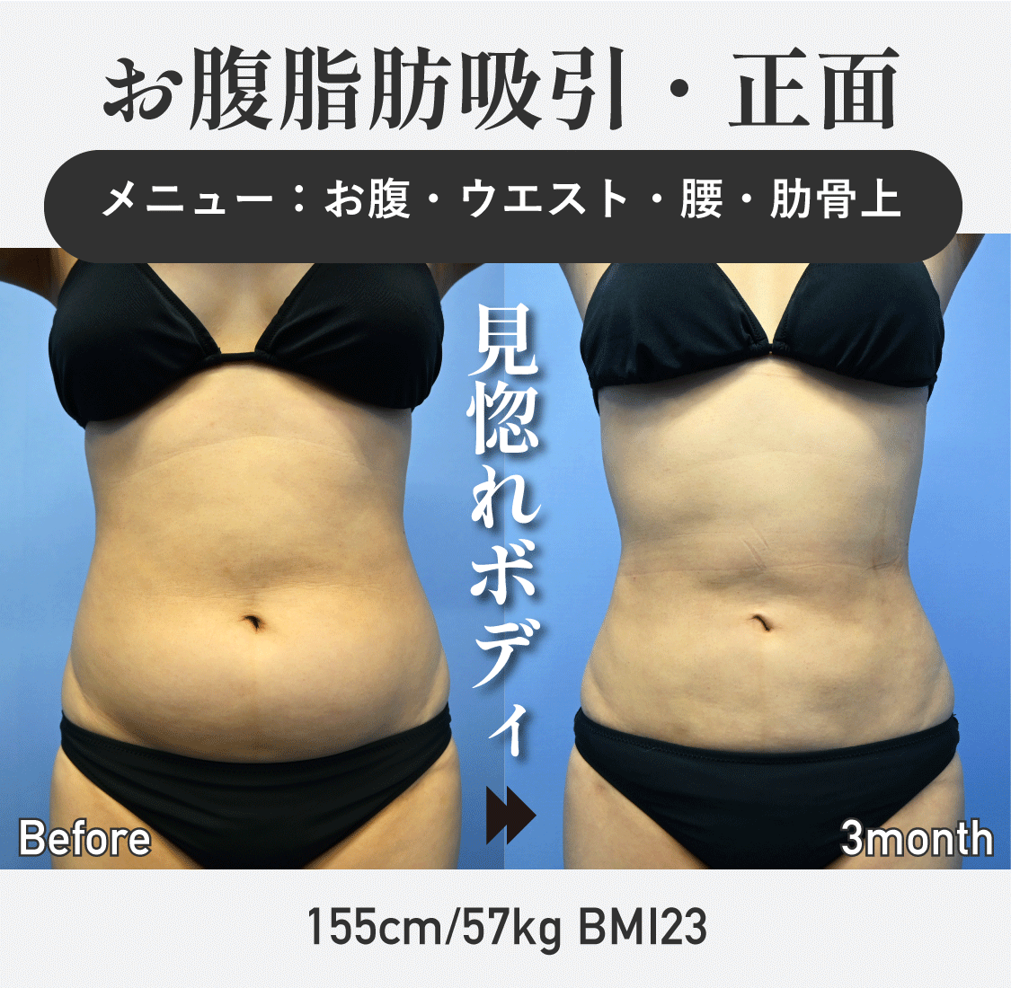 お腹 脂肪 吸引