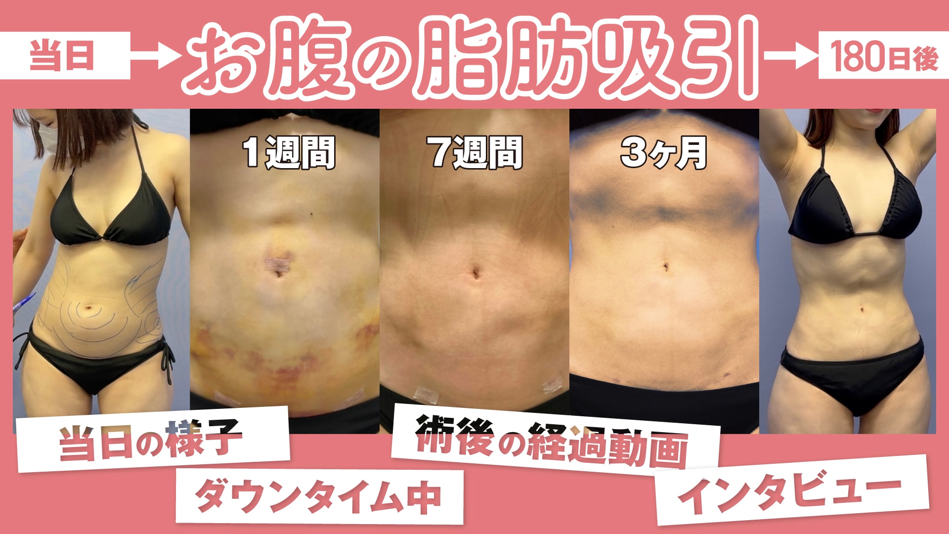 脂肪吸引ダウンタイム特集・お腹編】気になる経過圧迫期間拘縮体験談付きでお届けします！東京都内で無料カウンセリングなら【湘南美容・新橋銀座口の脂肪吸引】  - 新橋銀座口院