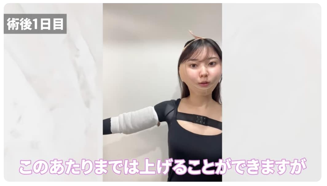 二の腕脂肪吸引 ボレロ 湘南美容クリニック