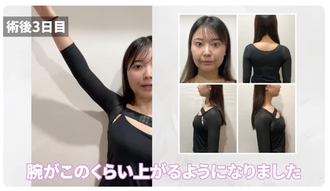 アミュレット sssサイズ 湘南美容外科 二の腕 脂肪吸引 ボレロ 着圧 圧迫 アミュレット 二の腕 脂肪 湘南美容クリニック　二の腕　脂肪吸引　着圧ボレロ　着圧インナー