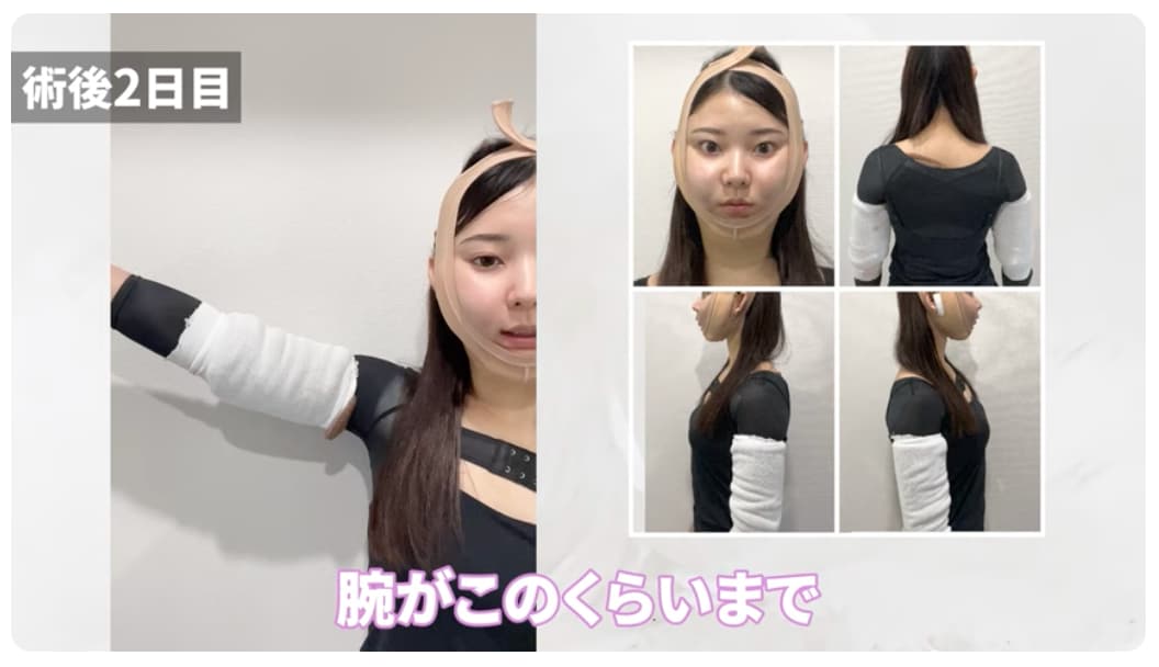 脂肪吸引ダウンタイム特集・二の腕編】後悔しない/ビフォーアフター 